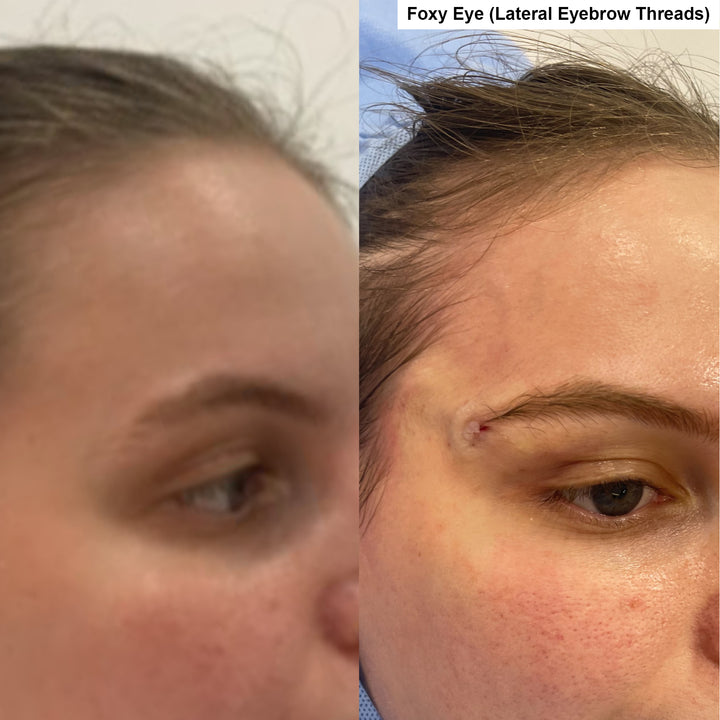 Threadlifting before and after_Lift Aesthetics Sydney