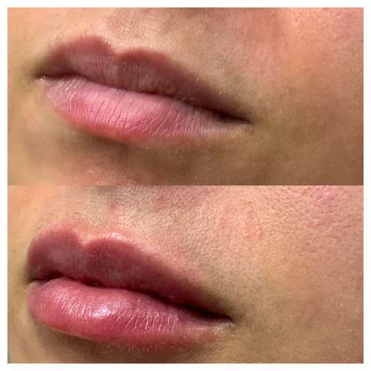 Lip filler before and after_Lift Aesthetics Sydney