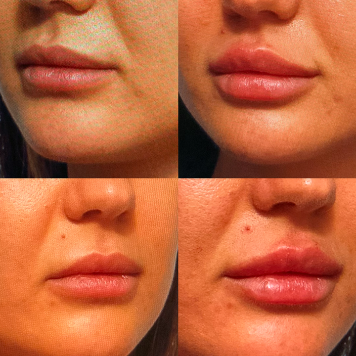 Lip filler before and after_Lift Aesthetics Sydney