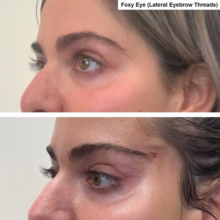 Threadlifting before and after_Lift Aesthetics Sydney